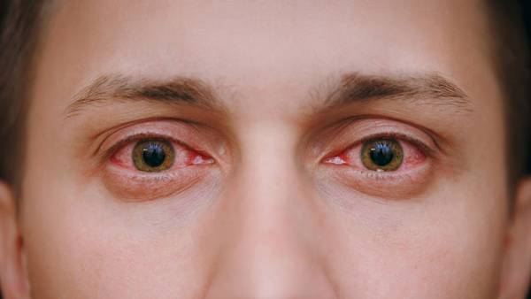 تاثیر ویروس کرونا بر چشم؛ آیا کرونا به بینایی آسیب می زند؟